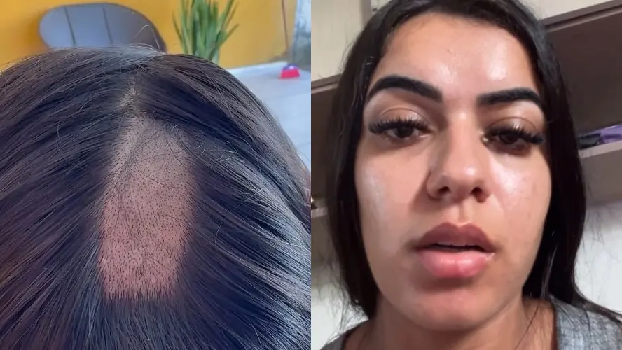 Mulher denuncia clínica após ter cabelo raspado em exame toxicológico para CNH